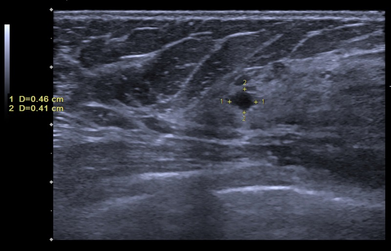 Hình ảnh siêu âm vú trên màn hình