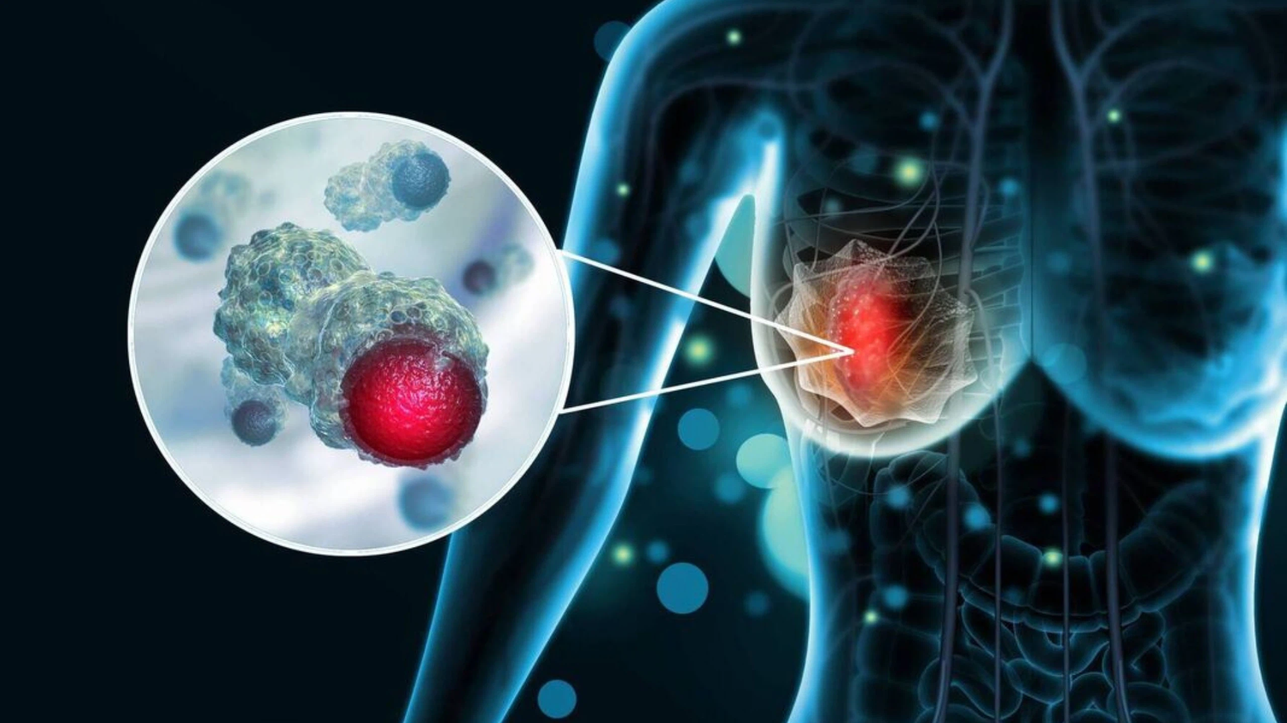 Chụp X-quang vú để làm gì? Vai trò và lợi ích trong tầm soát ung thư vú