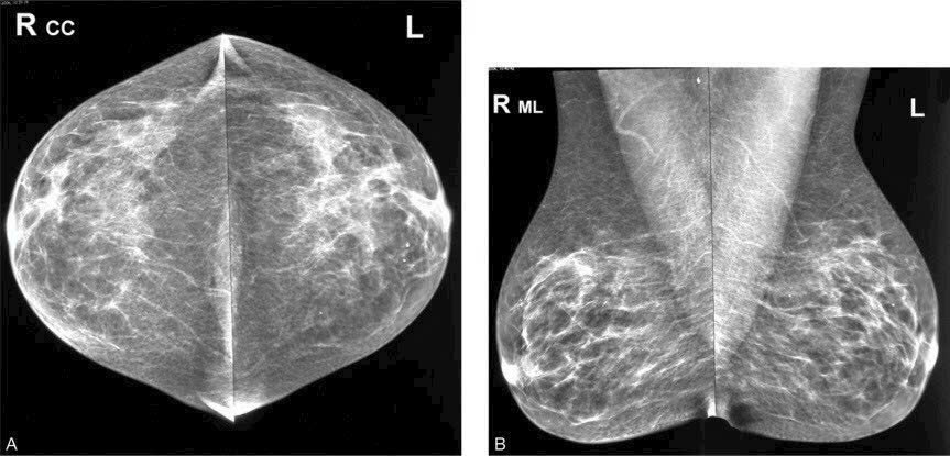 Khi Nghi Ngờ Một Bên Vú, Có Thể Chụp Một Bên X-quang Được Không?