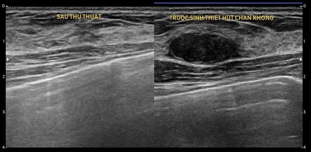 Chi phí hút VABB: Những điều cần biết về ung thư vú