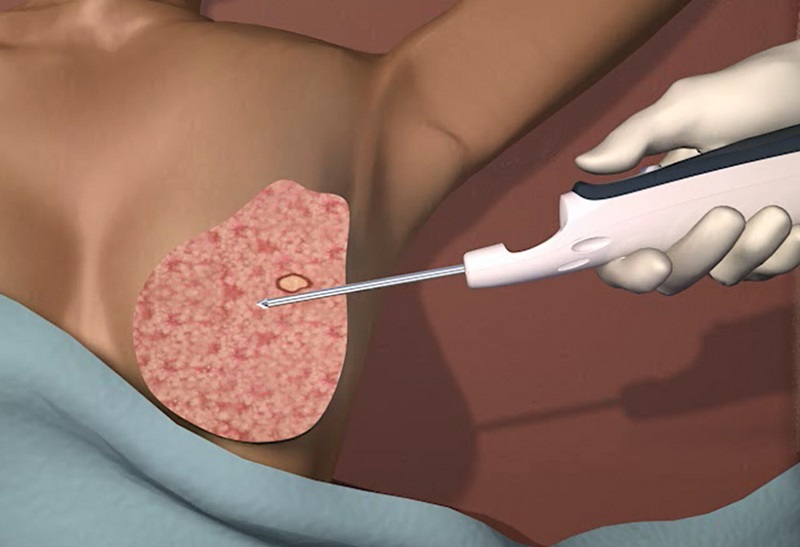 Sinh Thiết Vú: Phân Loại, Đối Tượng Và Quy Trình Thực Hiện