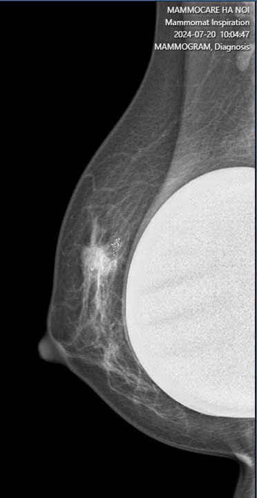 Mới Đặt Túi Ngực Được 6 Tháng, Chị N.T.P Được Chẩn Đoán Ung Thư Vú