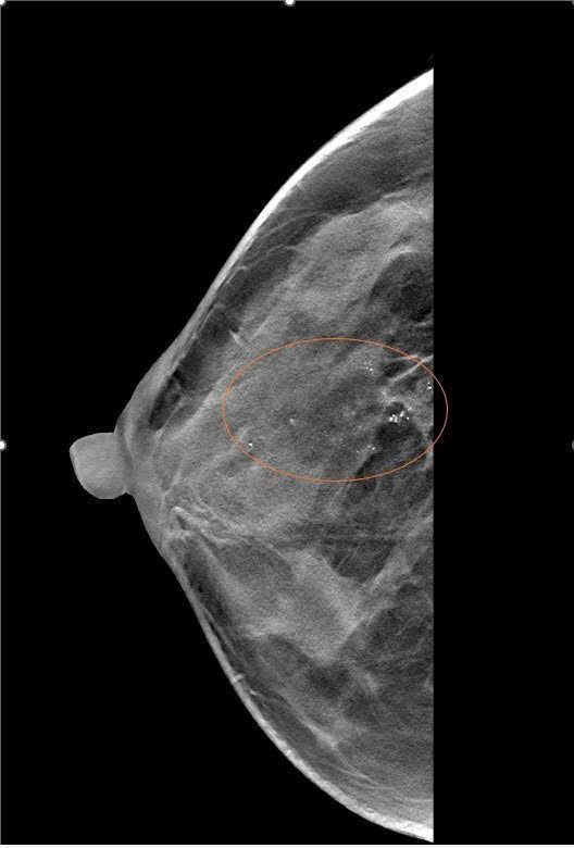 Bất Ngờ Từ Cuộc Tầm Soát: Khi Ung Thư Vú Không Chừa Một Ai