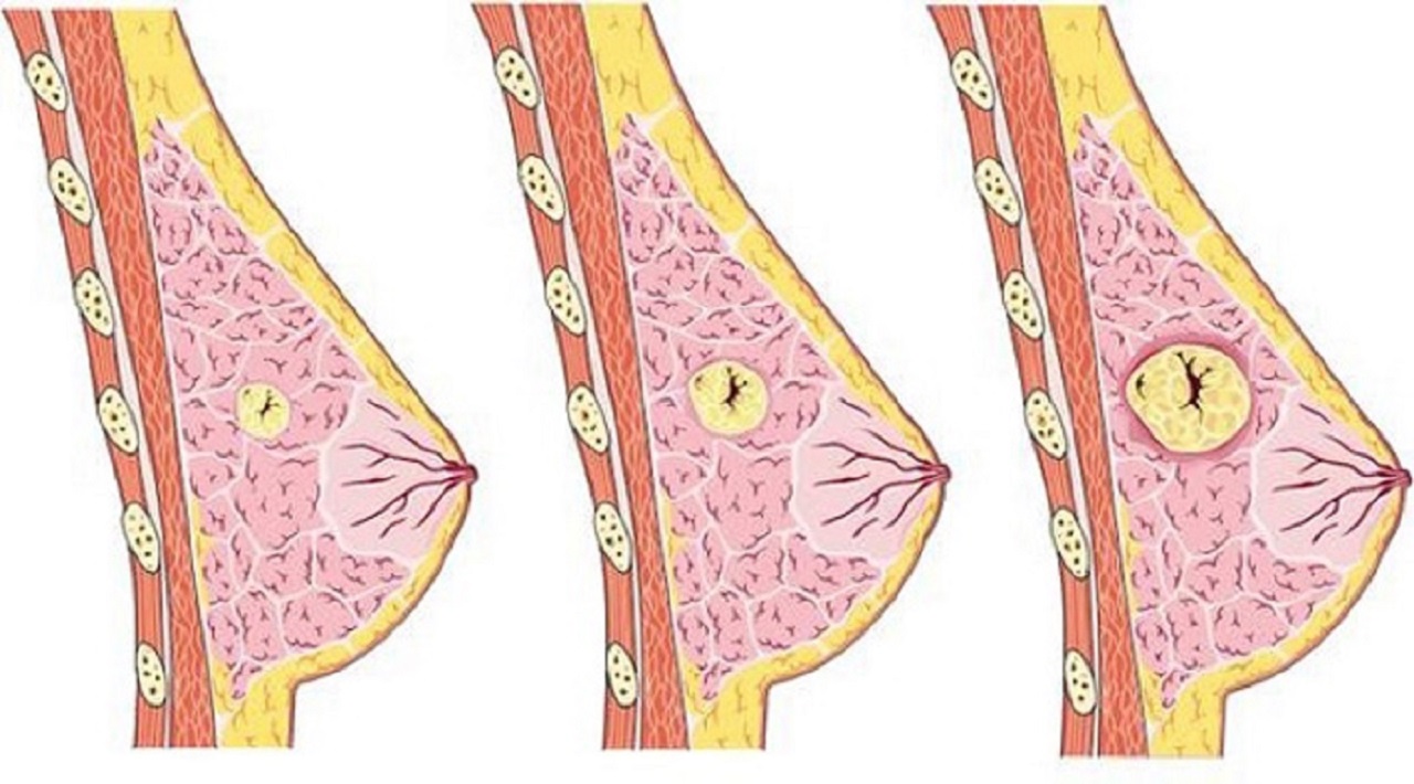 U Vú Lành Tính Có Chuyển Thành Ác Tính Không? Những Điều Cần Biết Về Các Loại U Vú