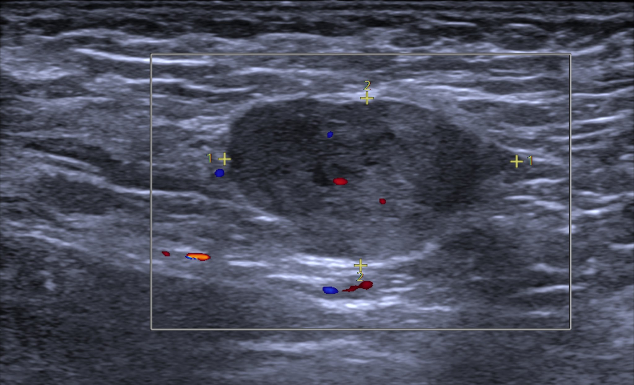 Phẫu Thuật Cắt U Vú (Mổ Mở) Tốt Hơn Hay Hút Chân Không VABB Các Khối U Vú Tốt Hơn?