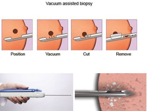 Phương pháp VABB: Giải pháp tiên tiến trong chẩn đoán và điều trị bệnh lý tuyến vú