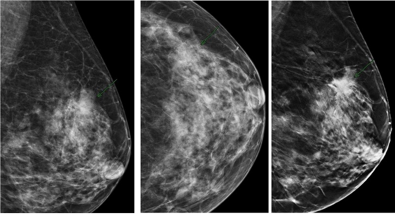 Chụp X Quang Tuyến Vú: Những Điều Bạn Cần Biết