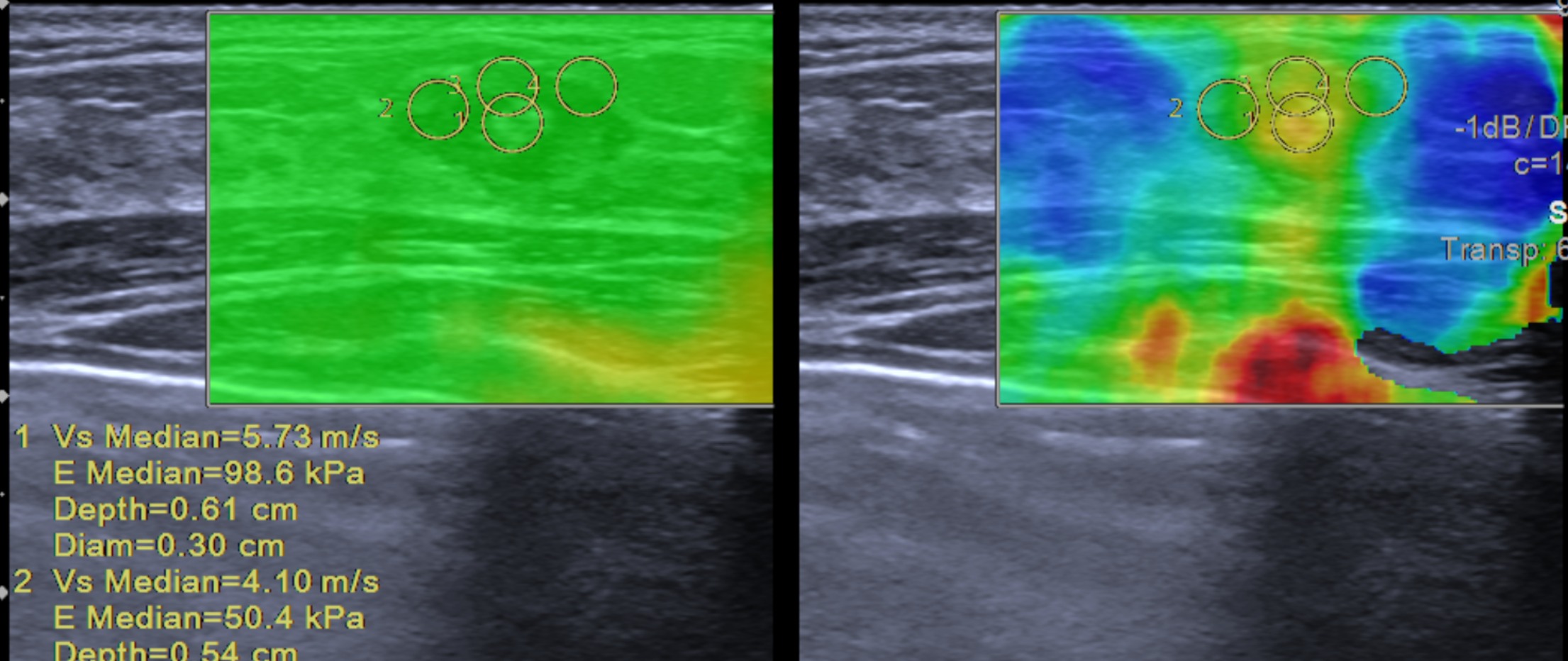 Siêu Âm Đàn Hồi: Phương Pháp Chẩn Đoán Tiên Tiến Cho Ung Thư Vú Tại Mammocare